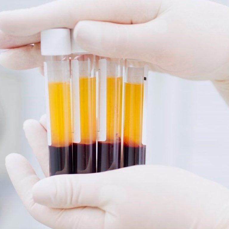 Plasma-rico-en-plaquetas