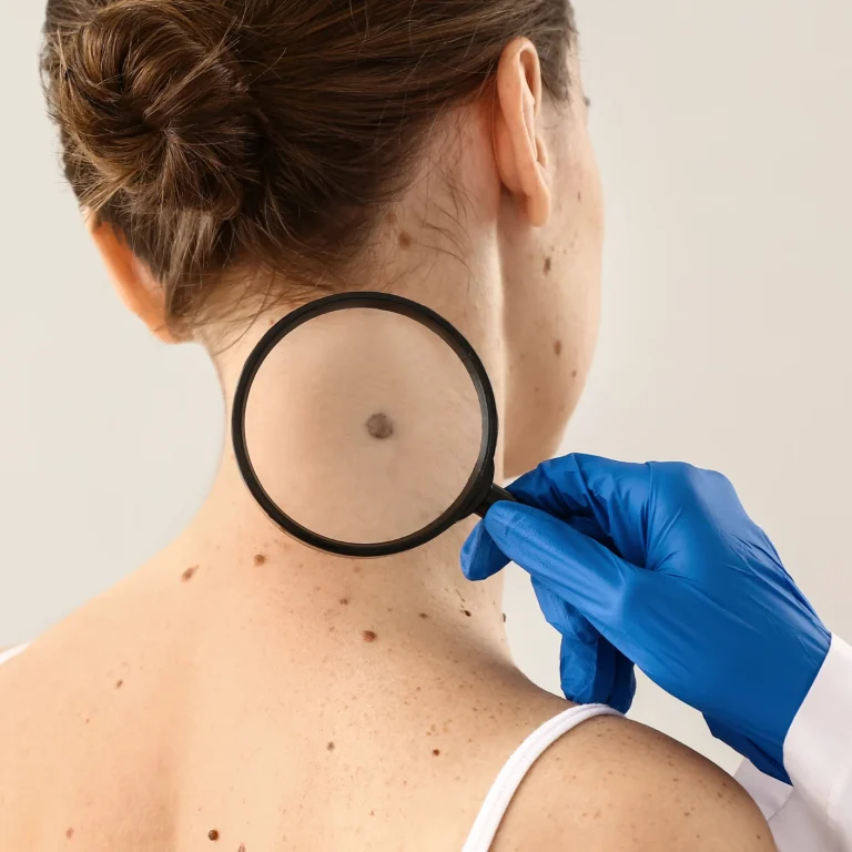 Retiro de Verrugas y Lunares