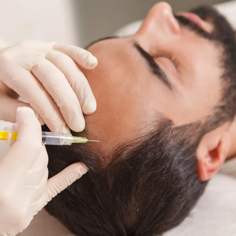 plasma-inyectado-cuero-cabelludo